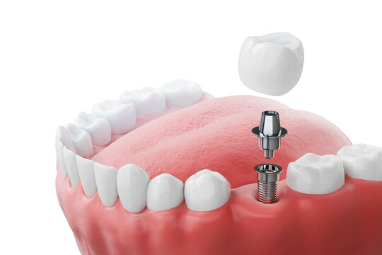 Имплантация зубов Neodent в Киеве и Львове: швейцарская надежность в Giorno Dentale
